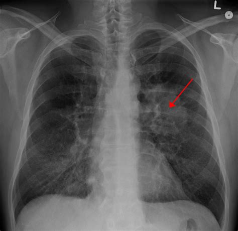 marker tumoral plamani|Profil neoplasm pulmonar